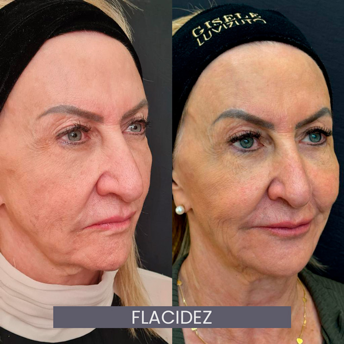 dra-gisele-luvizuto-flacidez