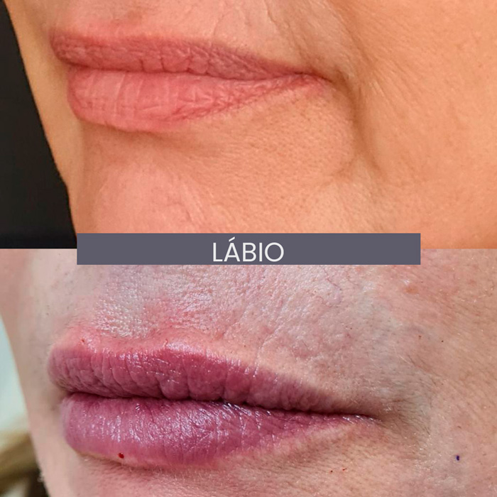 dra-gisele-luvizuto-labio1