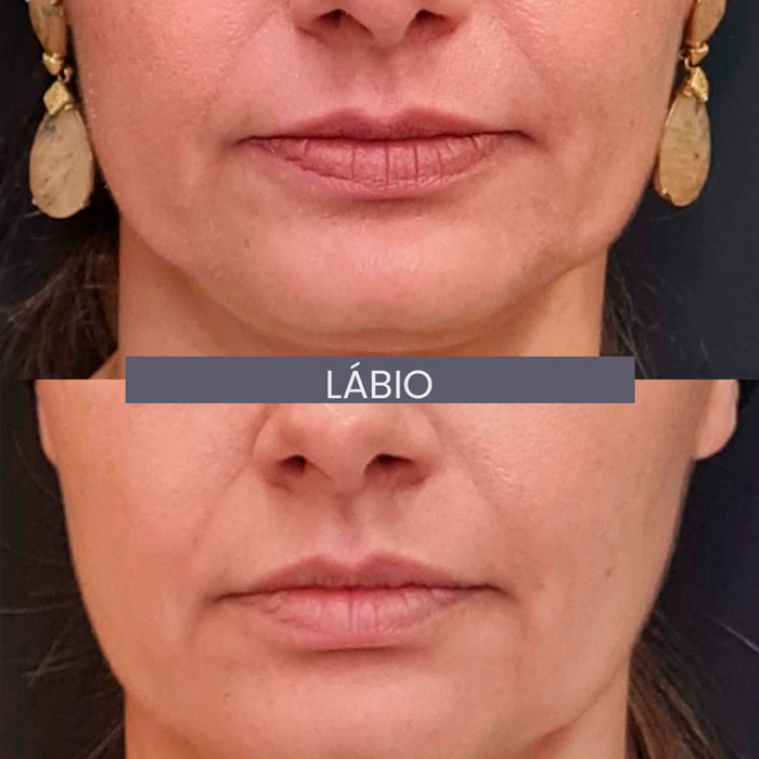 dra-gisele-luvizuto-labio3