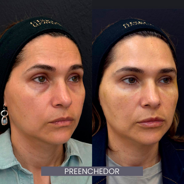 dra-gisele-luvizuto-preenchedor2